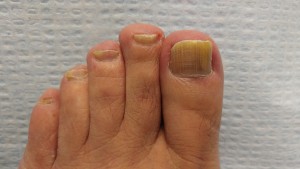 nail fungus